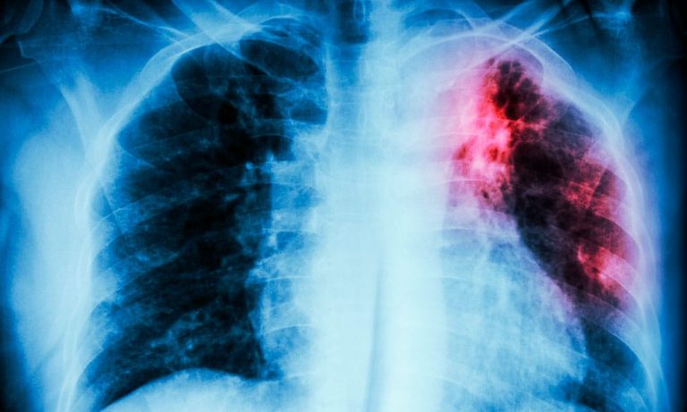 Que-es-la-tuberculosis-y-como-se-trata